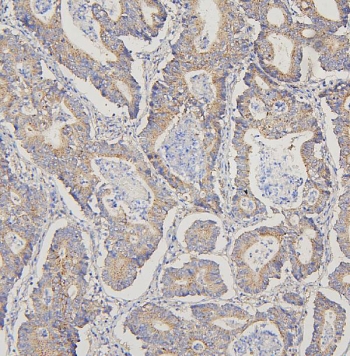 IHC staining of FFPE human intestinal cancer with TRPV3 antibody. HIER: boil tissue sections in pH6, 10mM citrate buffer, for 20 min and allow to cool before testing.