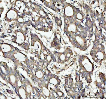 IHC staining of FFPE human lung cancer tissue with NOTCH2 antibody. HIER: boil tissue sections in pH8 EDTA for 20 min and allow to cool before testing.