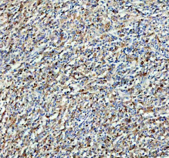 IHC staining of FFPE human lymphoma tissue with SYK antibody, HRP-secondary and DAB substrate. HIER: boil tissue sections in pH8 EDTA for 20 min and allow to cool before testing.
