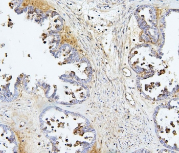 Immunohistochemistry analysis of TIE2 / TEK tyrosine kinase antibody in human ovarian cancer tissue. FFPE human ovarian carcinoma sections demonstrate HRP-DAB brown staining primarily in vascular endothelial cells within the tumor stroma, with membranous and cytoplasmic signal highlighting microvascular structures. Tumor epithelial cells show minimal to weak staining compared to endothelial components. Nuclear hematoxylin counterstain is visible in blue. Heat induced epitope retrieval was performed in 10 mM citrate buffer, pH 6.0, by boiling tissue sections for 20 minutes followed by cooling prior to antibody incubation.