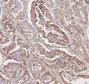 IHC staining of FFPE human intestinal cancer with Aldolase A antibody. HIER: boil tissue sections in pH6, 10mM citrate buffer, for 20 min and allow to cool before testing.