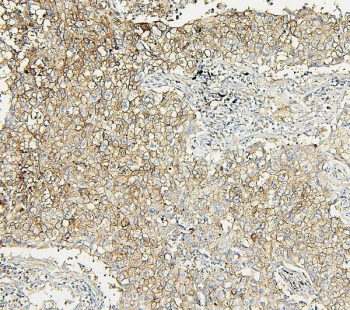 IHC staining of FFPE human lung cancer with Aldolase A antibody. HIER: boil tissue sections in pH6, 10mM citrate buffer, for 20 min and allow to cool before testing.