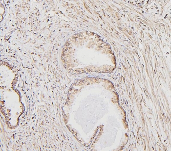 IHC staining of FFPE human prostate cancer with Calreticulin antibody. HIER: boil tissue sections in pH6, 10mM citrate buffer, for 20 min and allow to cool before testing.