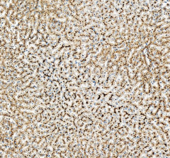 IHC staining of FFPE human liver cancer tissue with Beta Glucuronidase antibody, HRP-secondary and DAB substrate. HIER: boil tissue sections in pH8 EDTA for 20 min and allow to cool before testing.