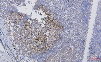 CD35 Antibody Human Tonsil Tissue Immunohistochemistry. IHC staining of FFPE human tonsil with CD35 antibody. HIER: boil tissue sections in pH8 EDTA for 20 min and allow to cool before testing.