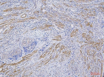 CD35 Antibody Endometrial Carcinoma IHC. Immunohistochemistry staining of FFPE human endometrial carcinoma tissue with CD35 antibody. HIER: boil tissue sections in pH8 EDTA for 20 min and allow to cool before testing.