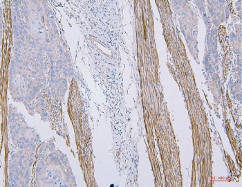CD35 Antibody Esophagus Squama Cancer IHC. Immunohistochemistry staining of FFPE human esophagus squama cancer tissue with CD35 antibody. HIER: boil tissue sections in pH8 EDTA for 20 min and allow to cool before testing.