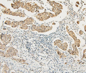 IHC staining of FFPE human breast cancer with ATRX antibody (nuclear and cytoplasmic staining seen here). HIER: boil tissue sections in pH6, 10mM citrate buffer, for 20 min and allow to cool before testing.