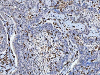 IHC staining of FFPE human laryngeal squamous cell carcinoma with HLA-DRA antibody. HIER: boil tissue sections in pH6, 10mM citrate buffer, for 20 min and allow to cool before testing.