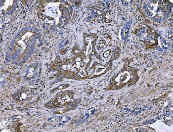 IHC staining of FFPE human gallbladder squamous cell carcinoma with IQGAP1 antibody. HIER: boil tissue sections in pH8 EDTA for 20 min and allow to cool before testing.