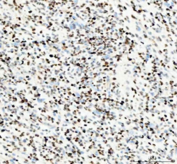 IHC staining of FFPE human glioblastoma tissue with PCNA antibody. HIER: boil tissue sections in pH8 EDTA for 20 min and allow to cool before testing.
