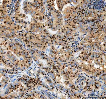 IHC staining of FFPE human papillary thyroid carcinoma tissue with PCNA antibody. HIER: boil tissue sections in pH8 EDTA for 20 min and allow to cool before testing.