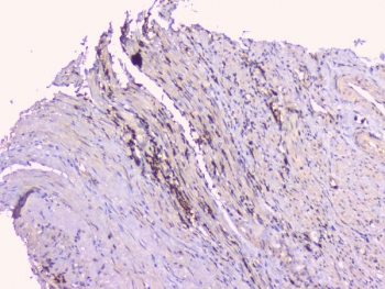 IHC staining of FFPE human endometrial carcinoma with TNFRSF11B antibody. HIER: boil tissue sections in pH6, 10mM citrate buffer, for 20 min and allow to cool before testing.