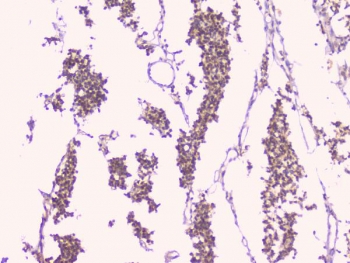 IHC staining of FFPE human glioma with TNFRSF11B antibody. HIER: boil tissue sections in pH6, 10mM citrate buffer, for 20 min and allow to cool before testing.