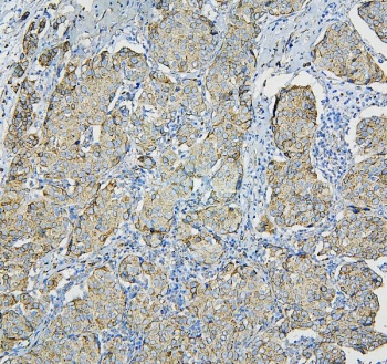 IHC staining of FFPE human breast cancer with RPL13A antibody. HIER: boil tissue sections in pH6, 10mM citrate buffer, for 20 min and allow to cool before testing.