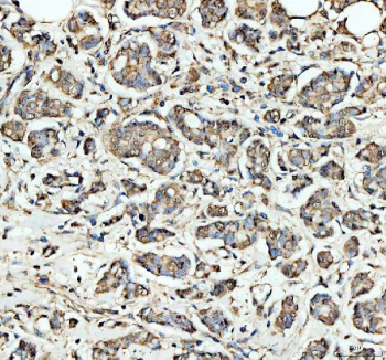 IHC staining of FFPE human breast cancer tissue with SKP1 antibody. HIER: boil tissue sections in pH8 EDTA buffer for 20 min and allow to cool before testing.