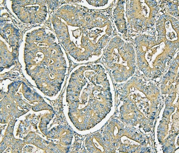 IHC staining of FFPE human colon cancer with MVP antibody. HIER: boil tissue sections in pH6, 10mM citrate buffer, for 20 min and allow to cool before testing.