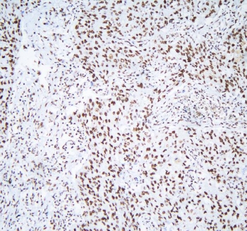 IHC staining of FFPE human lung cancer with AUF1 antibody. HIER: boil tissue sections in pH8 EDTA for 20 min and allow to cool before testing.