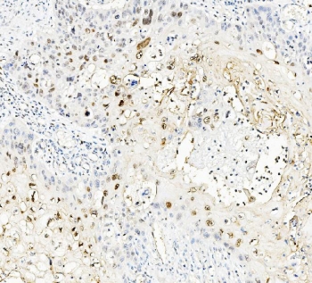 IHC staining of FFPE human esophagus squama cancer with MAFA antibody. HIER: boil tissue sections in pH8 EDTA for 20 min and allow to cool before testing.