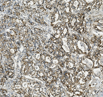 IHC staining of FFPE human stomach cancer with TXN2 antibody. HIER: boil tissue sections in pH8 EDTA for 20 min and allow to cool before testing.