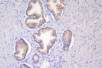 Desmoglein 2 Antibody Prostate Cancer IHC. Immunohistochemistry analysis of FFPE human prostate cancer tissue stained with Desmoglein 2 antibody detecting DSG2. Tumor epithelial glands show membranous and cytoplasmic staining with clear accentuation along cell-cell borders, consistent with localization of DSG2 within desmosomal adhesion complexes that maintain epithelial cohesion and structural integrity. Surrounding stromal tissue shows minimal staining. Hematoxylin counterstain highlights nuclei in blue. HIER: boil tissue sections in pH 8 EDTA for 20 min and allow to cool before testing.