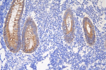Desmoglein 2 Antibody Appendicitis IHC. Immunohistochemistry analysis of FFPE human appendicitis tissue stained with Desmoglein 2 antibody detecting DSG2. Intestinal epithelial cells show membranous and cytoplasmic staining with clear localization at cell-cell junctions, consistent with DSG2 presence in desmosomal adhesion complexes that maintain epithelial cohesion. The staining outlines glandular structures within inflamed tissue, while surrounding inflammatory infiltrates show minimal signal. Hematoxylin counterstain highlights nuclei in blue. HIER: boil tissue sections in pH 8 EDTA for 20 min and allow to cool before testing.