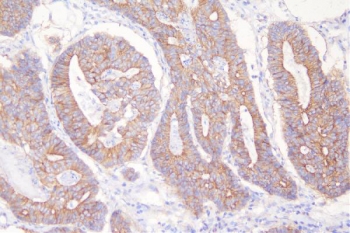 Desmoglein 2 Antibody Rectal Cancer IHC. Immunohistochemistry analysis of FFPE human rectal cancer tissue stained with Desmoglein 2 antibody detecting DSG2. Tumor epithelial glands exhibit strong membranous and cytoplasmic staining with clear accentuation at cell-cell borders, consistent with localization of DSG2 within desmosomal adhesion complexes that maintain epithelial cohesion and structural integrity. The staining highlights glandular architecture within malignant tissue, while surrounding stromal elements show minimal signal. Hematoxylin counterstain highlights nuclei in blue. HIER: boil tissue sections in pH 8 EDTA for 20 min and allow to cool before testing.