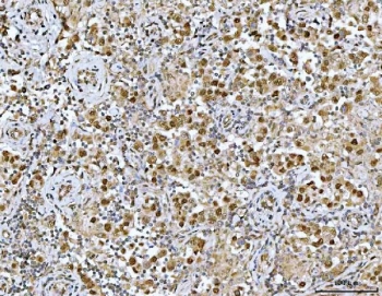 IHC staining of FFPE human seminoma testis tissue with Neurofibromin antibody. HIER: boil tissue sections in pH8 EDTA for 20 min and allow to cool before testing.