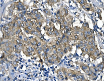 Immunohistochemistry analysis of RENT1 / hUPF1 antibody in human breast cancer tissue. FFPE human breast carcinoma shows cytoplasmic HRP-DAB brown staining in tumor epithelial cells, consistent with RENT1 expression. Staining is predominantly cytoplasmic with variable intensity among malignant cells, while nuclei are counterstained blue. Adjacent stromal elements demonstrate comparatively weaker staining. Heat induced epitope retrieval was performed by boiling tissue sections in EDTA buffer, pH 8.0, for 20 minutes followed by cooling prior to immunostaining.