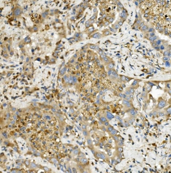 IHC staining of FFPE human lung cancer with HK1 antibody. HIER: boil tissue sections in pH8 EDTA for 20 min and allow to cool before testing.