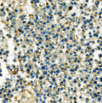 IHC staining of FFPE human testis cancer with HK1 antibody. HIER: boil tissue sections in pH8 EDTA for 20 min and allow to cool before testing.