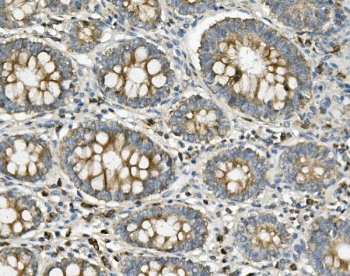 IHC staining of FFPE human rectal cancer with ME2 antibody. HIER: boil tissue sections in pH8 EDTA for 20 min and allow to cool before testing.