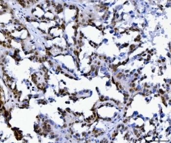 IHC staining of FFPE human ovarian serous adenocarcinoma tissue with Muscleblind-like 1 antibody. HIER: boil tissue sections in pH8 EDTA for 20 min and allow to cool before testing.
