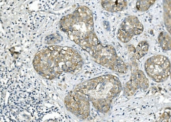 IHC staining of FFPE human breast cancer with BUB1B antibody. HIER: boil tissue sections in pH8 EDTA for 20 min and allow to cool before testing.