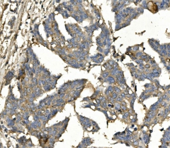 IHC staining of FFPE human ovarian cancer with BUB1B antibody. HIER: boil tissue sections in pH8 EDTA for 20 min and allow to cool before testing.