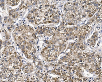 IHC staining of FFPE human liver cancer with Patched 2 antibody. HIER: boil tissue sections in pH8 EDTA for 20 min and allow to cool before testing.