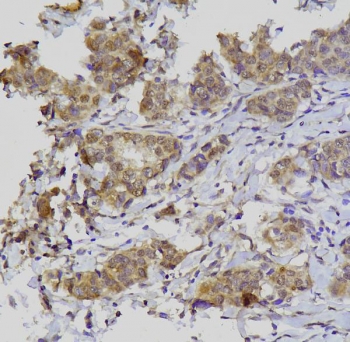 GATA3 Antibody Breast Cancer IHC. Immunohistochemistry analysis of FFPE human breast cancer tissue stained with GATA3 Antibody / Multi-Application Research Antibody demonstrates moderate to strong predominantly nuclear HRP-DAB brown staining within malignant epithelial cell populations, consistent with the established role of GATA binding protein 3 / GATA3 in luminal epithelial differentiation and breast lineage-associated transcriptional regulation. Focal cytoplasmic background staining is also present within tumor-associated cellular regions. HIER: boil tissue sections in pH 8 EDTA for 20 min and allow to cool before testing.