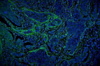 Vinculin Antibody Breast Cancer IF. Immunofluorescent staining of FFPE human breast cancer tissue with Vinculin antibody (green) and DAPI nuclear stain (blue). HIER: steam section in pH6 citrate buffer for 20 min.