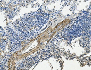 Vinculin Antibody Lung Cancer IHC. Immunohistochemistry staining of FFPE human lung cancer with Vinculin antibody. HIER: boil tissue sections in pH8 EDTA for 20 min and allow to cool before testing.