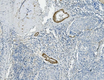 Vinculin Antibody Human Lung Cancer Tissue IHC. IHC staining of FFPE human lung cancer with Vinculin antibody. HIER: boil tissue sections in pH8 EDTA for 20 min and allow to cool before testing.