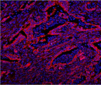 Immunofluorescent staining of FFPE human intestinal cancer with CAV2 antibody (red) and DAPI nuclear stain (blue). HIER: steam section in pH8 EDTA buffer for 20 min.