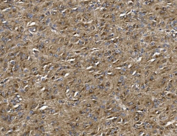 IHC staining of FFPE human glioma with ALDH1L1 antibody. HIER: boil tissue sections in pH8 EDTA for 20 min and allow to cool before testing.