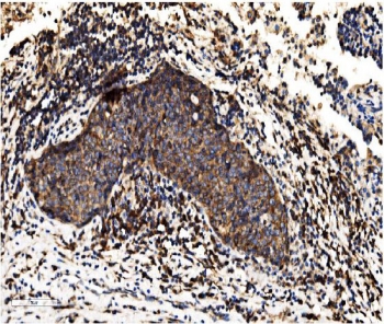 ALPL Antibody Lung Cancer IHC. Immunohistochemistry analysis of FFPE human lung carcinoma tissue stained with ALPL Antibody / Phosphate Metabolism Enzyme Antibody. Tumor epithelial cells demonstrate diffuse cytoplasmic and membranous HRP-DAB brown staining, while surrounding stromal and inflammatory cell populations show comparatively lower background reactivity. The staining pattern is consistent with expression of alkaline phosphatase, tissue-nonspecific isozyme / ALPL, a phosphate metabolism enzyme associated with epithelial differentiation and metabolic remodeling pathways in tumor tissue. HIER: boil tissue sections in pH8 EDTA for 20 min and allow to cool before testing.
