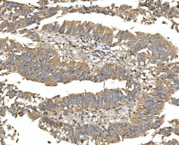 ALPL Antibody Rectal Cancer IHC. Immunohistochemistry analysis of FFPE human rectal carcinoma tissue stained with ALPL Antibody / Phosphate Metabolism Enzyme Antibody. Malignant gland-forming epithelial cells demonstrate strong apical membranous and granular cytoplasmic HRP-DAB brown staining, with prominent signal localized along luminal tumor surfaces and differentiated epithelial compartments. The staining profile is consistent with expression of alkaline phosphatase, tissue-nonspecific isozyme / ALPL, a phosphate metabolism enzyme involved in epithelial differentiation and extracellular phosphate regulation pathways. HIER: boil tissue sections in pH8 EDTA for 20 min and allow to cool before testing.