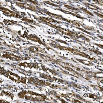 IHC staining of FFPE human gastric cancer with MitoNEET antibody. HIER: boil tissue sections in pH8 EDTA for 20 min and allow to cool before testing.