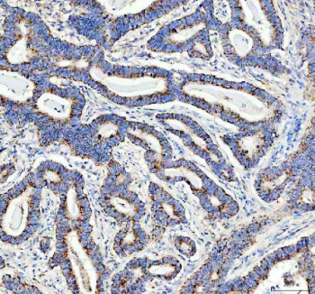 IHC staining of FFPE human stomach cancer with DDX6 antibody. HIER: boil tissue sections in pH8 EDTA for 20 min and allow to cool before testing.