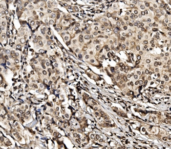 IHC staining of FFPE human breast cancer with HIF1A antibody. HIER: boil tissue sections in pH8 EDTA for 20 min and allow to cool before testing.