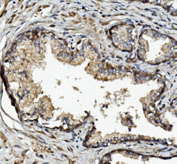 IHC staining of FFPE human prostate cancer with MMP2 antibody. HIER: boil tissue sections in pH8 EDTA for 20 min and allow to cool before testing.