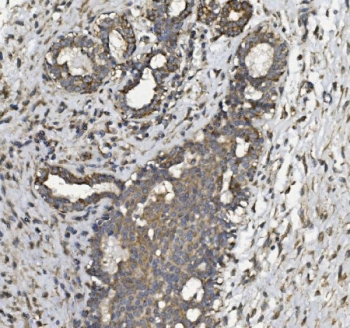 IHC staining of FFPE human breast cancer with PHB2 antibody. HIER: boil tissue sections in pH8 EDTA for 20 min and allow to cool before testing.