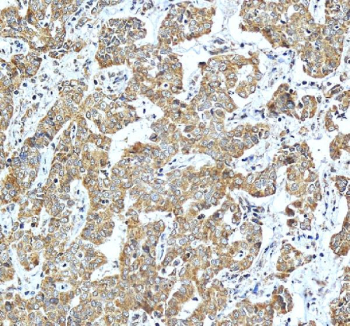 IHC staining of FFPE human liver cancer tissue with ACADSB antibody, HRP-secondary and DAB substrate. HIER: boil tissue sections in pH8 EDTA for 20 min and allow to cool before testing.